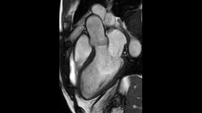 BTFE Tratto di efflusso ventricolare sinistro
