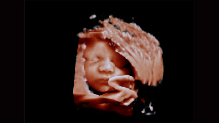 Viso del feto con sistema ecografico Philips Affiniti, aReveal non applicato