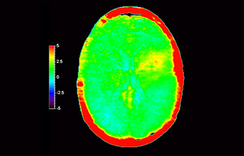 Lesione cerebrale