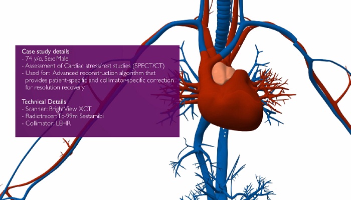 Innovativo algoritmo di ricostruzione SPECT